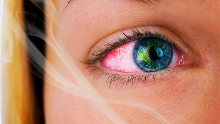 why-does-weed-make-your-eyes-red-and-how-to-get-rid-of-red-eyes