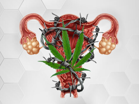 Can Cannabis Be Used To Treat Polycystic Ovary Syndrome (PCOS)?