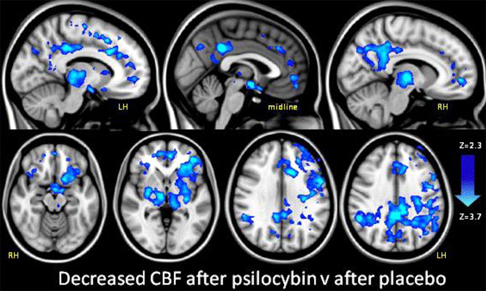 Psylocibin vs placebo