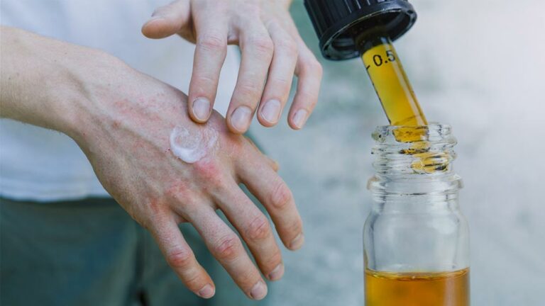 CBD-for-eczema