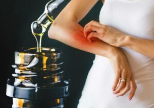 CBD for Psoriasis: Overview of Existing Studies