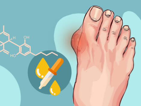 CBD Oil for Gout: Help for Inflammation and Pain